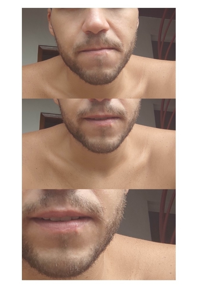 Epi-lef